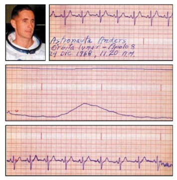Registro electrocardiográfico de William Anders. Tomado de Iglesias Leal, Cardiología aeroespacial (2012).